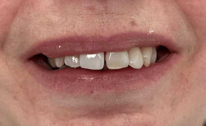 After - Hanwell Dental Centre